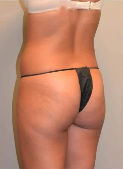 Brazilian Butt Lift With Fat Transfer Before & After Case 3957