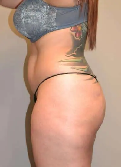 Brazilian Butt Lift With Fat Transfer Before & After Case 3930