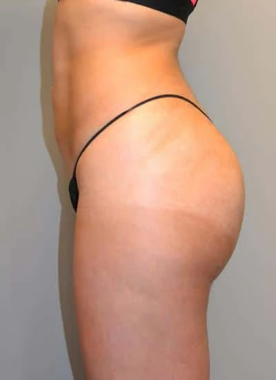 Brazilian Butt Lift With Fat Transfer Before & After Case 3874