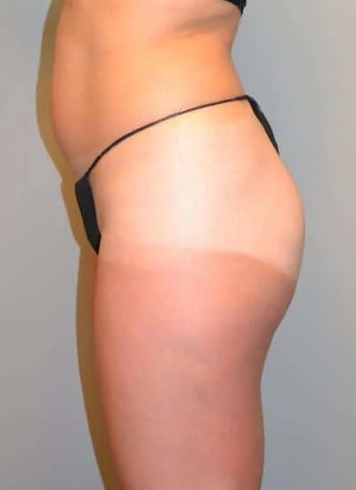 Brazilian Butt Lift With Fat Transfer Before & After Case 3874