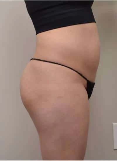 Brazilian Butt Lift With Fat Transfer Before & After Case 3986