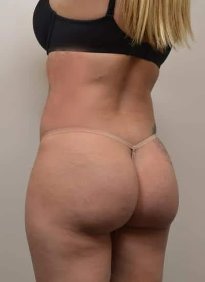 Brazilian Butt Lift With Fat Transfer Before & After Case 3979