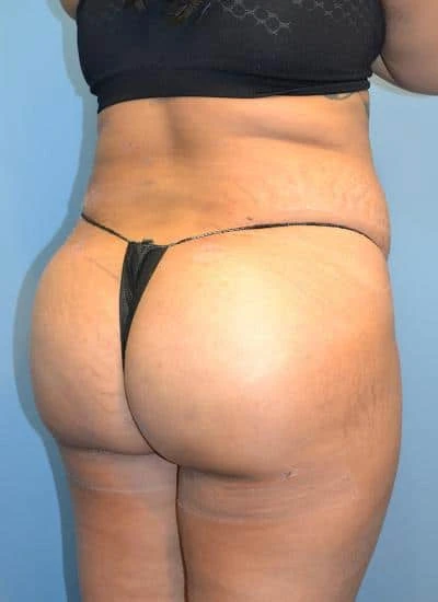 Brazilian Butt Lift With Fat Transfer Before & After Case 4023