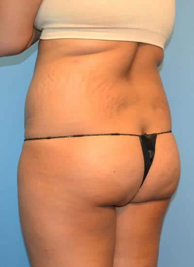 Brazilian Butt Lift With Fat Transfer Before & After Case 4023