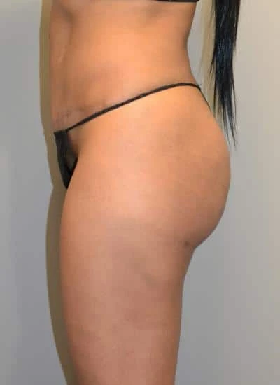 Brazilian Butt Lift With Fat Transfer Before & After Case 4000