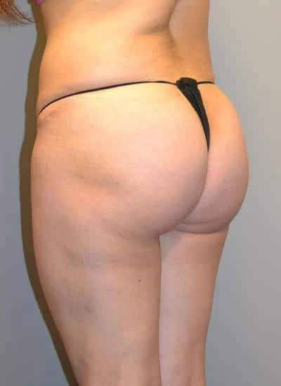 Brazilian Butt Lift With Fat Transfer Before & After Case 3993