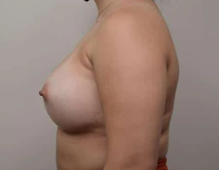 Breast Augmentation Before & After Case 4616