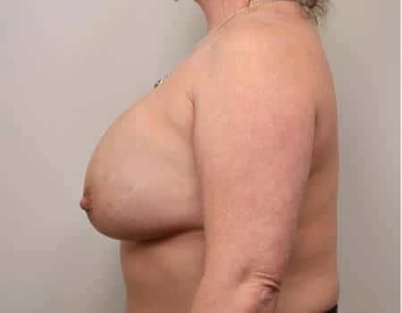Breast Augmentation Before & After Case 4609