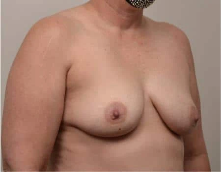 Breast Augmentation Before & After Case 4602