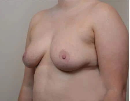 Breast Augmentation Before & After Case 4531
