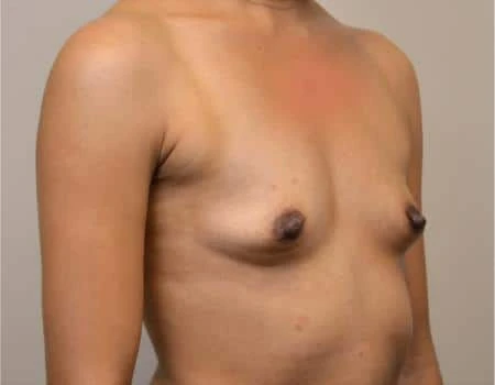 Breast Augmentation Before & After Case 4509