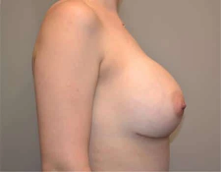 Breast Augmentation Before & After Case 4480