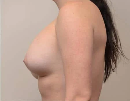 Breast Augmentation Before & After Case 4473