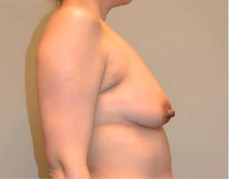 Breast Augmentation Before & After Case 4458