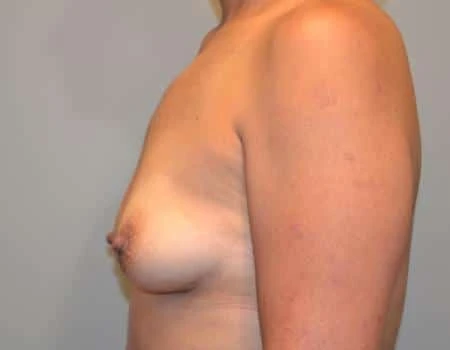 Breast Augmentation Before & After Case 4437