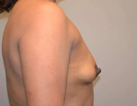 Breast Augmentation Before & After Case 4407