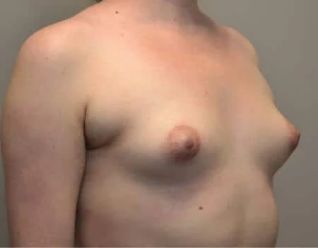 Breast Augmentation Before & After Case 4392