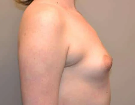 Breast Augmentation Before & After Case 4392