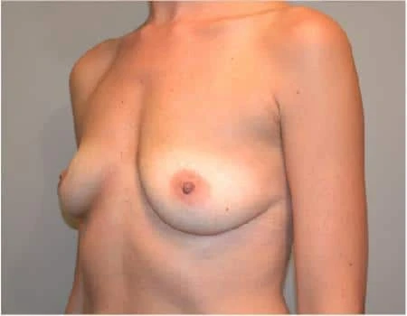 Breast Augmentation Before & After Case 4385