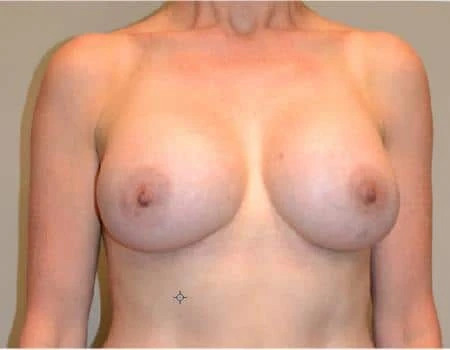 Breast Augmentation Before & After Case 4383