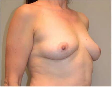 Breast Augmentation Before & After Case 4383