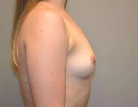 Breast Augmentation Before & After Case 4361