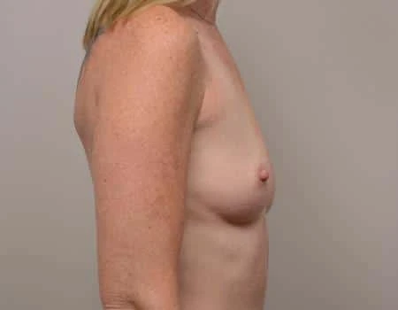 Breast Augmentation Before & After Case 4658