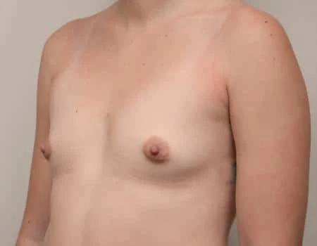 Breast Augmentation Before & After Case 4644