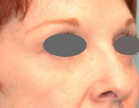 Botox Before & After Case 5333