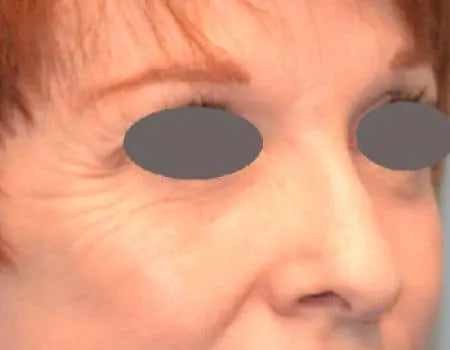 Botox_01_before