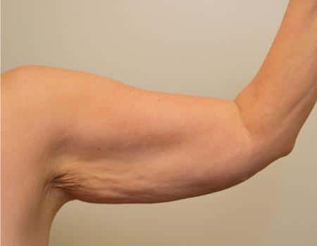 Arm Lift Before & After Case 4050