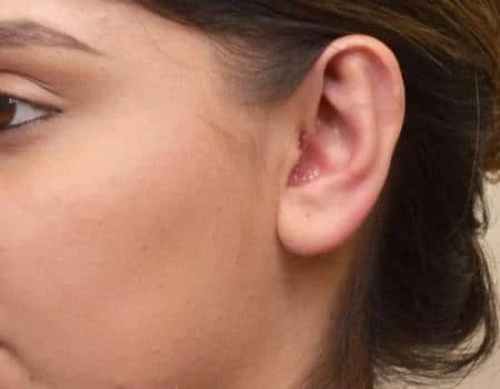 Ear Surgery (Otoplasty) Before & After Case 5116