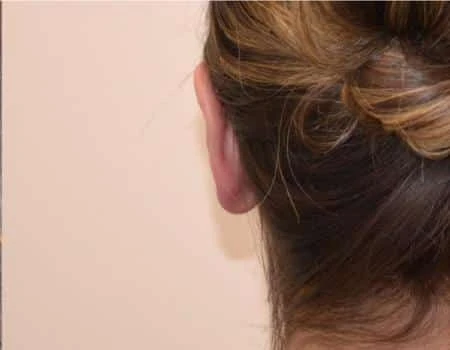 Ear Surgery (Otoplasty) Before & After Case 5116