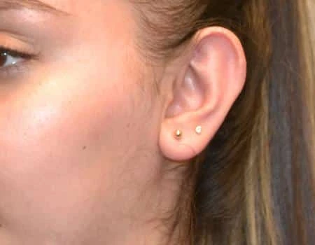 Ear Surgery (Otoplasty) Before & After Case 5116