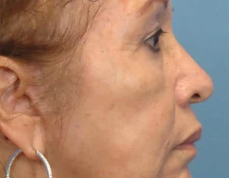 Eyelid Surgery (Blepharoplasty) Before & After Case 5039