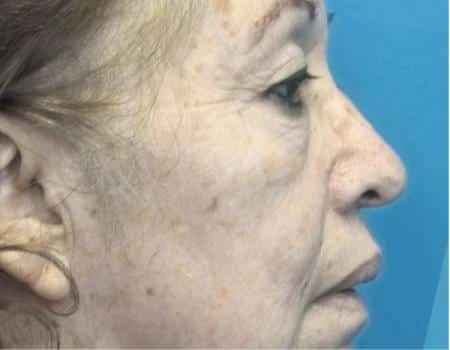 Eyelid Surgery (Blepharoplasty) Before & After Case 5039