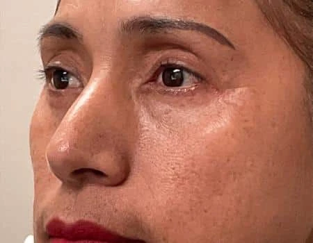 Eyelid Surgery (Blepharoplasty) Before & After Case 5032