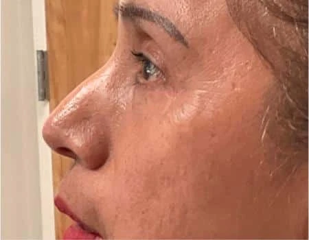 Eyelid Surgery (Blepharoplasty) Before & After Case 5032