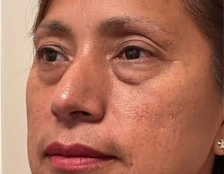 Eyelid Surgery (Blepharoplasty) Before & After Case 5032