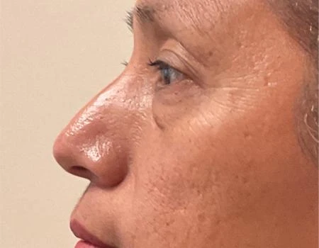 Eyelid Surgery (Blepharoplasty) Before & After Case 5032