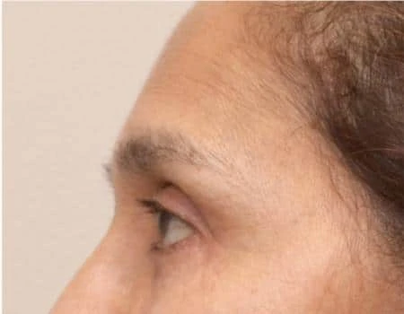 Eyelid Surgery (Blepharoplasty) Before & After Case 5025