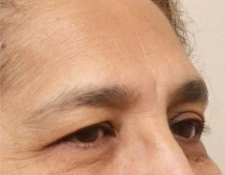Eyelid Surgery (Blepharoplasty) Before & After Case 5025