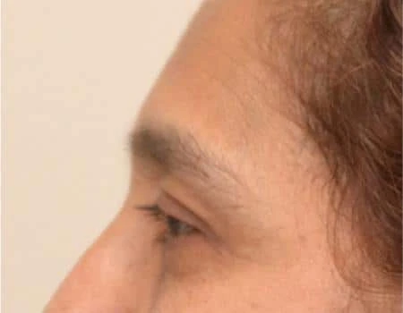 Eyelid Surgery (Blepharoplasty) Before & After Case 5025