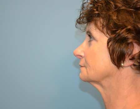 Eyelid Surgery (Blepharoplasty) Before & After Case 5018