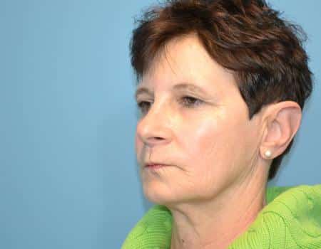 Eyelid Surgery (Blepharoplasty) Before & After Case 5018