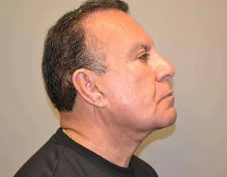 Eyelid Surgery (Blepharoplasty) Before & After Case 5011