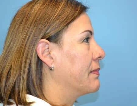 Eyelid Surgery (Blepharoplasty) Before & After Case 5004