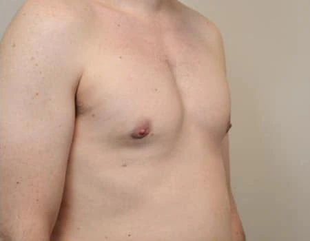 Gynecomastia Before & After Case 4914