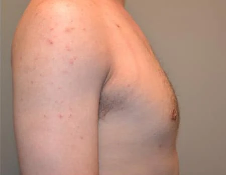 Gynecomastia Before & After Case 4907