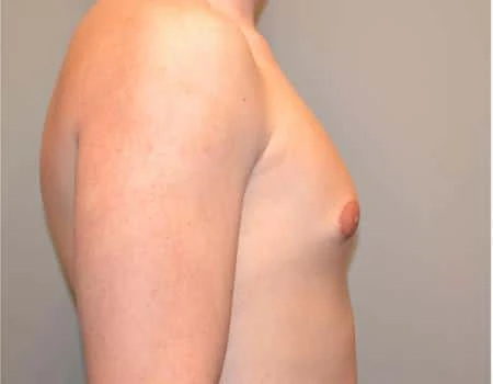 Gynecomastia Before & After Case 4872